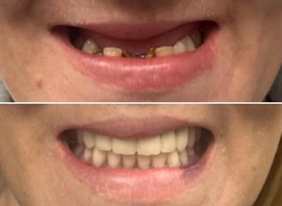 Full Smile Restoration