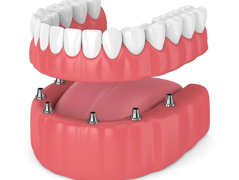 Conventional vs. immediate full dentures