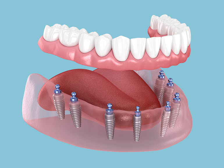 Implant-supported dentures in Tuscaloosa, AL