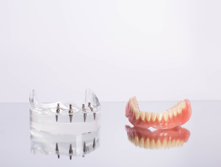 How implant-supported dentures work